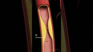 Atherosclerosis viralreels anatomy biology physiotharapist exercise doctorscience [upl. by Rubina550]