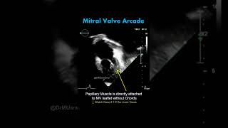 Mitral Valve Arcade on Echocardiogram Shorts echocardiography Hammock Mitral valve cardiology [upl. by Uke216]