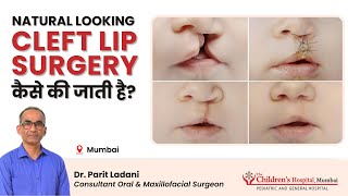 Cleft Lip and Palate Surgery which looks Natural by Dr Parit Ladani [upl. by Mendel]