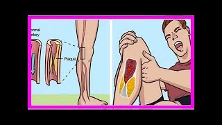 6 anticoagulants naturels pour prévenir la formation de caillots dans le sang [upl. by Sewellyn]