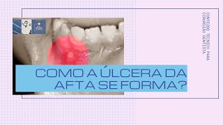 Como a úlcera da afta se forma A explicação técnica ao cirurgião dentista  Prof Mauricio Volkweis [upl. by Ardene310]