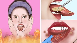 ASMR Canker sores cause of mouth ulcer treatment  Tonsil stone removal animation [upl. by Piscatelli]