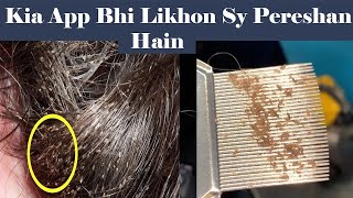 How to Remove Lice from Hair  Effective Lice Treatment amp Nits Removal at Home [upl. by Esenej]