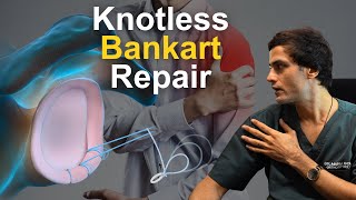 कंधा बारबार उतर रहा है Recurrent Shoulder Dislocation Treatment Knotless Bankart Repair [upl. by Ellennod901]