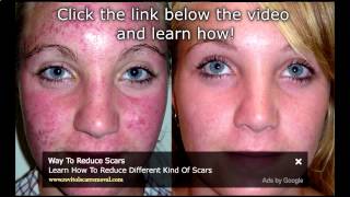 How To Cure Blotchy Skin  Skin Care Tips Blotchy Skin On Face [upl. by Malcah]