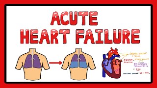 Acute Heart Failure  Types of Acute Heart Failure  Causes  Signs and Symptoms [upl. by Amyas563]