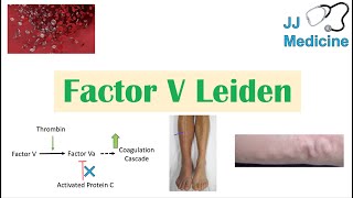 Factor V Leiden  Causes Pathophysiology Symptoms Diagnosis Treatment [upl. by Aicram]