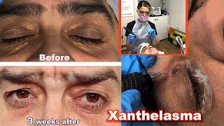 Xanthelasma removal treatment with Plasma Pen  before and after amazing transformation 2023 [upl. by Dustin625]