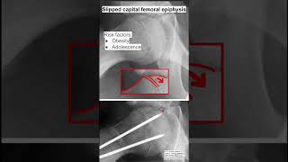 Slipped capital femoral epiphysis [upl. by Eagle561]