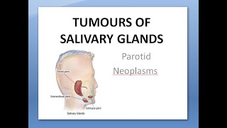 ENT Tumors of Salivary Glands Parotid Neoplasms Benign Malignant Pleomorphic Warthin Cylindroma [upl. by Acinoed]