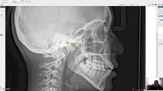 Tutorial para hacer una cefalometria digital Nemoceph [upl. by Rebmak]