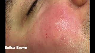 Christians Acne Treatment  Blackheads Extractions [upl. by Elatnahs844]