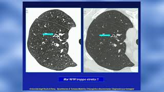 07 Lessenziale nellinterpretazione della HRCT Luca Volterrani [upl. by Rehportsirhc705]