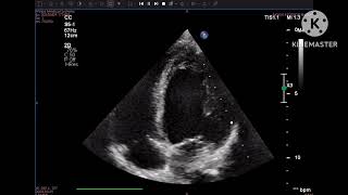 Hypertensive CMP due to fibromuscular dysplasia of renal artery [upl. by Amekahs]