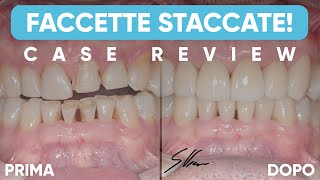 Faccette dentali STACCATE perché succede [upl. by Earezed]