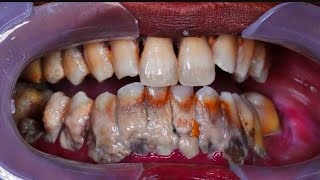 ScalingTeeth Cleaning  Should you get it done [upl. by Ecertak]