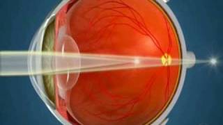 How Orthokeratology Works [upl. by Enyale665]