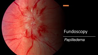 Papilledema Fundoscopy [upl. by Enyalb242]