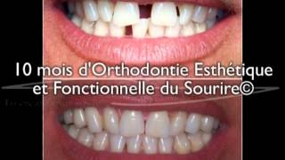 Dents écartées  diastème sur un adulte  correction avec 10 mois daligneurs® en OEFS© [upl. by Eedeed]