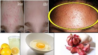 6 Best Ways To Get Rid Of Bumps On Forehead [upl. by Wilsey911]