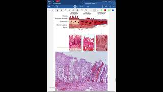 Ischemic bowel disease [upl. by Eesyak]