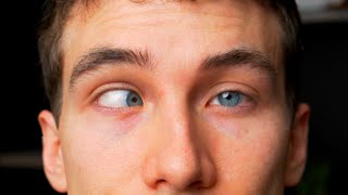 CROSS EYED What is Strabismus  Types Causes Treatments Eye Doctor Explains [upl. by Marjana]