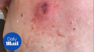 Gross moment a 25yearold cyst is popped and oozes pus [upl. by Fuchs]