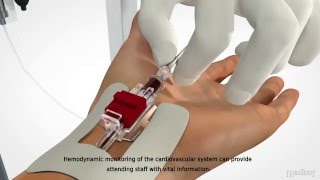 MEDBAR  Arterial Cannula [upl. by Stefa973]