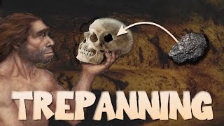 The History of Trepanning [upl. by Nosnehpets]