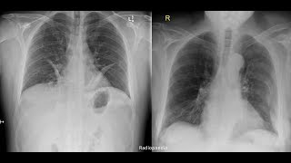 Hemothorax pneumothorax pleural effusion [upl. by Ennairej]