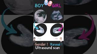 Ultrasound boy or girl ultrasoundpics ultrasound baby babyboy pregancyultrasound [upl. by Bigner40]