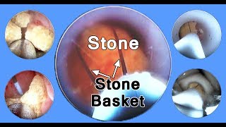 PCNL Percutaneous Nephrolithotomy Kidney Stone Removal Technique [upl. by Harriett]