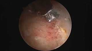 Hip Labral Tear debridement and Repair [upl. by Kolodgie]