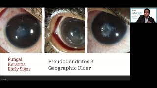 Lecture Microbial Keratitis Update for General Ophthalmologists [upl. by Aicirtam758]