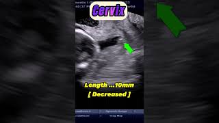 Cervical incompetence  This is Emergence  21wks Pregnancy ultrasound miscarriage baby [upl. by Suoivatnod]