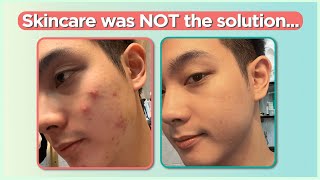 Confused sa pag treat ng ACNE Start here Beginners Guide  Jan Angelo [upl. by Barnum783]