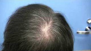 Dr Hasson Hair Transplant  8800 grafts  2 Sessions [upl. by Laural120]