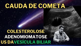 Colesterolose e Adenomiomatose da Vesícula Biliar [upl. by Omer]