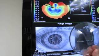 THE BASICS OF CORNEAL TOPOGRAPHY AND ITS USE IN DESIGNING LENSES [upl. by Thebazile918]