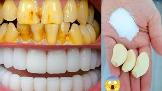 सिर्फ 2 मिनट में गंदे दांतों को मोती की तरह चमका देगा यह घरेलू नुस्खा Teeth Whitening Remedy [upl. by Ellerol]