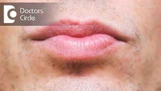 What causes discoloration below lip amp its management  Dr Sachith Abraham [upl. by Suzann]