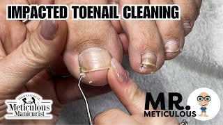 How to Fix Ingrown  Impacted Toenails at Home nails satisfying [upl. by Aniluap217]