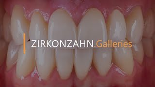 Minimally invasive restoration with ultrathin zirconia veneers  ZirkonzahnGalleries [upl. by Yltsew813]