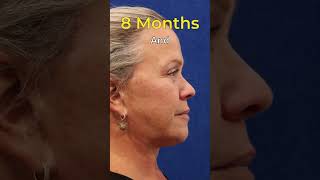 Facelift  Neck Lift  Blepharoplasty  Stunning Results [upl. by Nuawed]