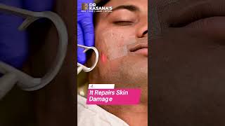 co2 laser treatment for acne scars  DrLalit Kasanas [upl. by Marci]