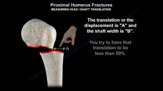 Proximal Humerus Fracture  Everything You Need To Know  Dr Nabil Ebraheim [upl. by Adiela113]