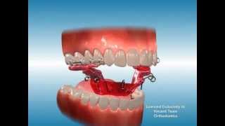 Palatal Expander [upl. by Schott]