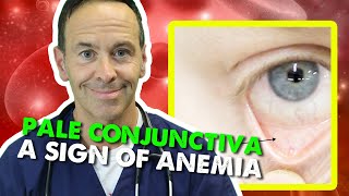 Pale Conjunctiva  A Sign of Anemia [upl. by Merri180]