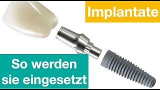 So werden Implantate eingesetzt [upl. by Nidya]