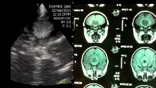 VSCAN Intraoperative quotpocketquot ultrasound Cerebellar Vermis Medulloblastoma [upl. by Dom100]